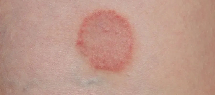 O que é tinea capitis e como pode ser tratada?