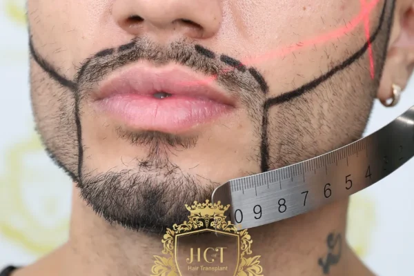 Was ist eine Schnurrbarttransplantation?