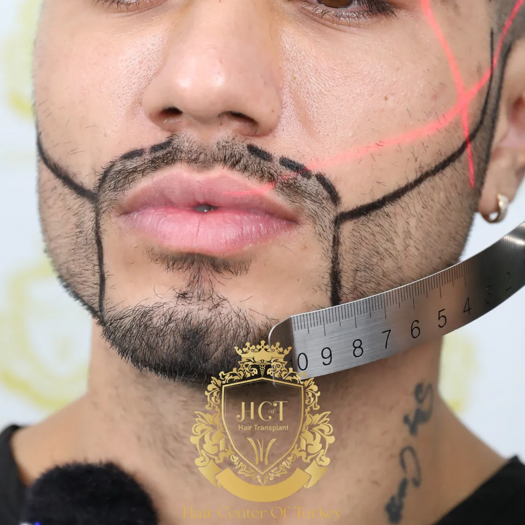 ¿Qué es un trasplante de bigote?