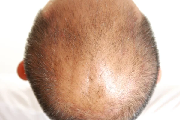 Best Hair Loss Treatments in 2026: Proven Solutions, New Breakthroughs & Expert Advice