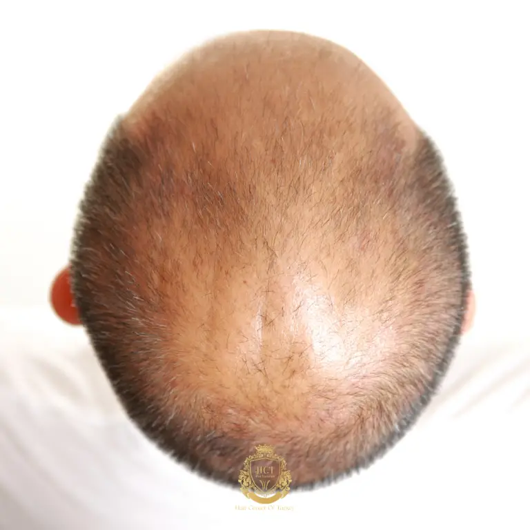 Quels sont les traitements les plus efficaces contre la chute des cheveux ?