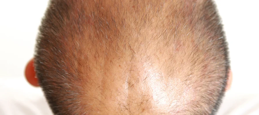 Quais são os tratamentos mais eficazes para a queda de cabelo?