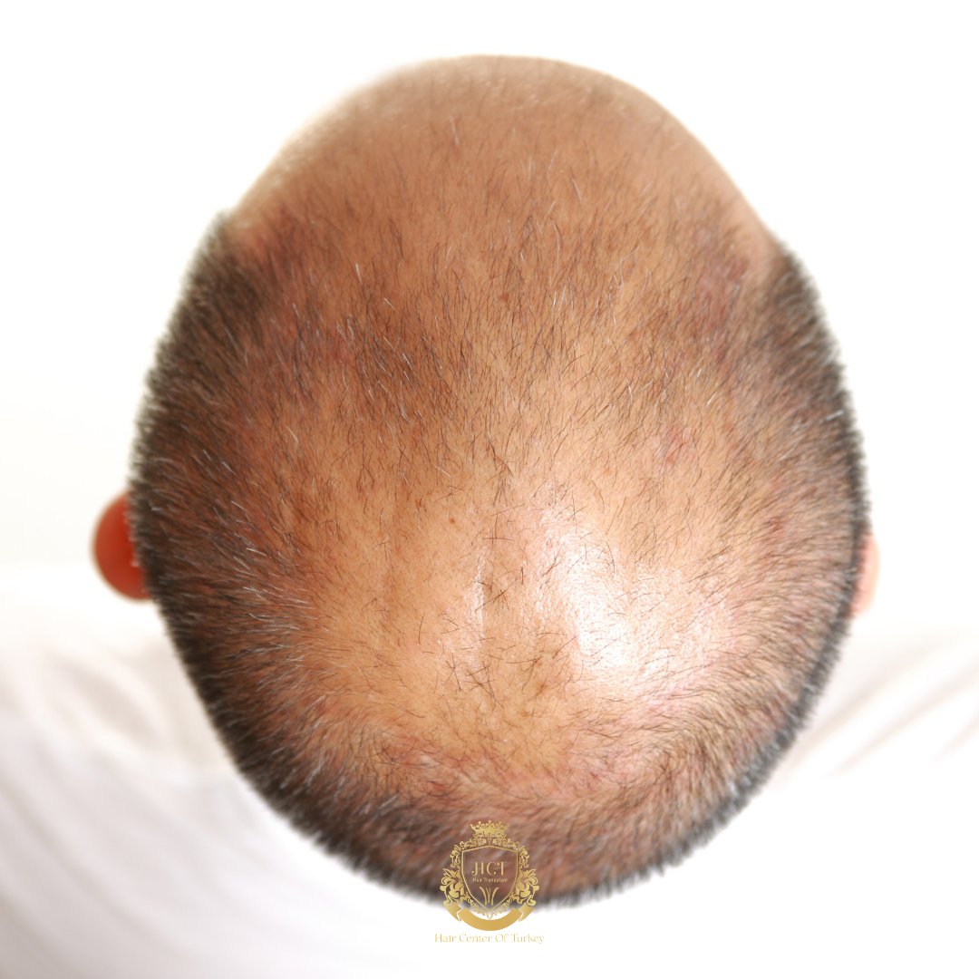 Best Hair Loss Treatments in 2026: Proven Solutions, New Breakthroughs & Expert Advice 4 What are the most effective hair loss treatments