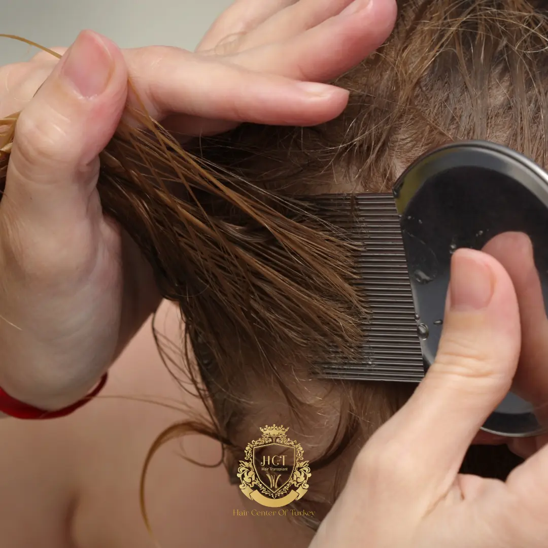 What Causes Head Lice? | How Does Hair Loss Affect?