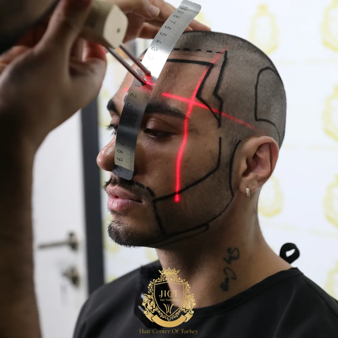 When Is the Best Season for Beard Transplant F