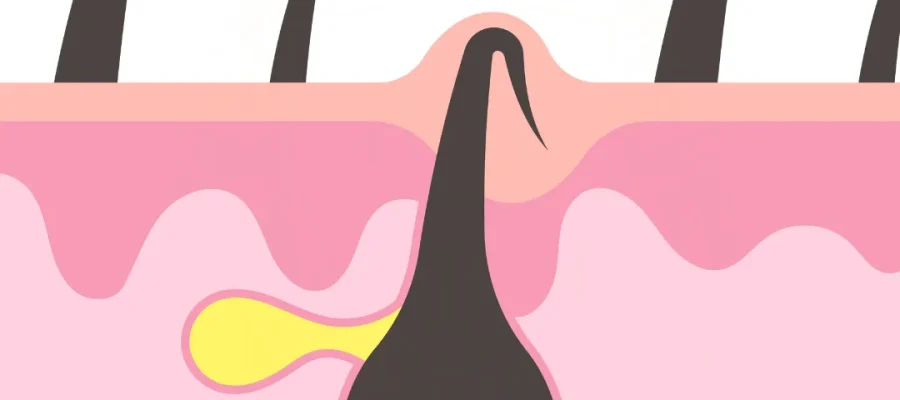 ¿Qué remedios caseros funcionan mejor para el vello encarnado?