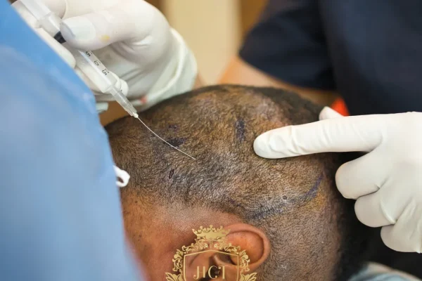 Welche Anästhesieart ist die beste für eine Haartransplantation?