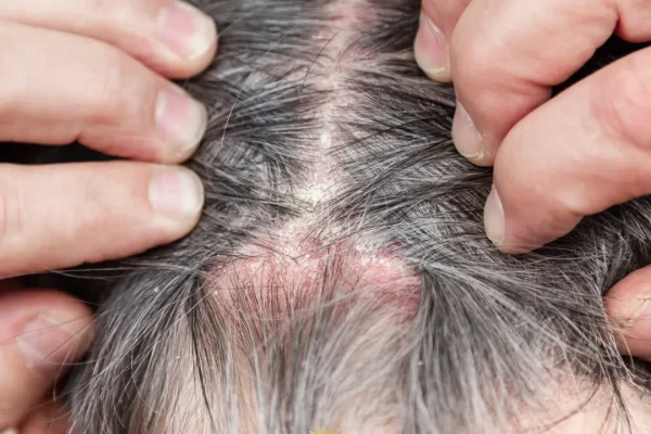 Pourquoi Les Racines Des Cheveux Font-elles Mal ? Causes Des Douleurs Du Cuir Chevelu Et Soulagement Rapide