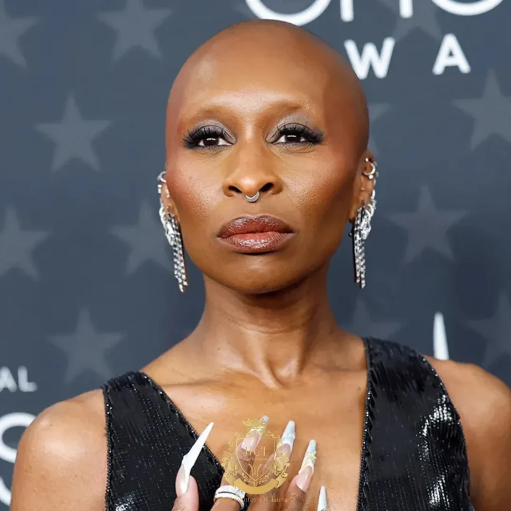 Cynthia Erivo neden kel?
