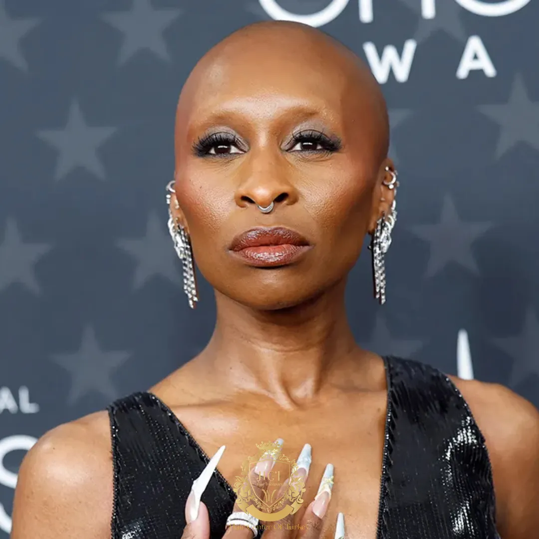 Why Is Cynthia Erivo Bald