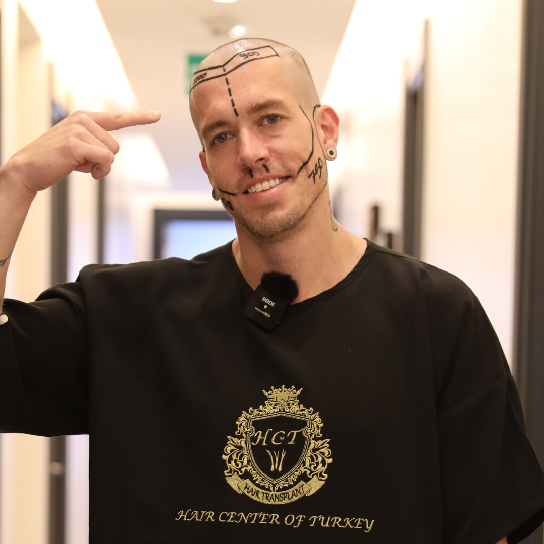 Why is Turkey Such a Popular Destination for Hair Transplants