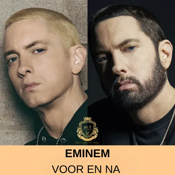 Eminem Haartransplantatie Eminem Haartransplantatie