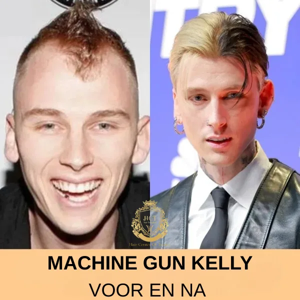 Timbaland Haartransplantatie 79 MGK Haartransplantatie