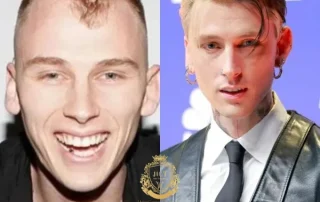 Maschinengewehr Kelly Haartransplantation 4 MGK Haartransplantation