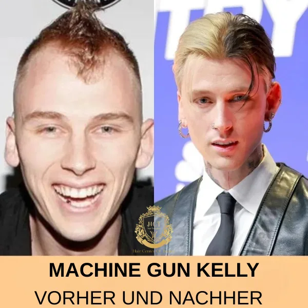 MGK Haartransplantation MGK Haartransplantation