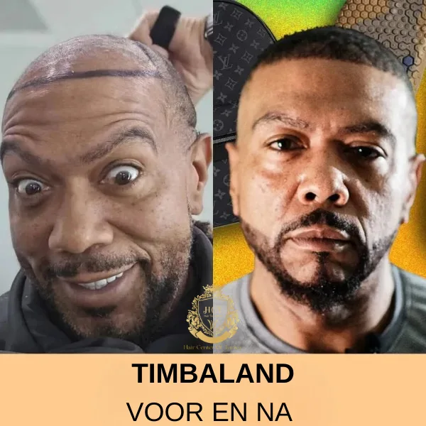 Machine Gun Kelly Haartransplantatie 78 Timbaland-Haartransplantatie