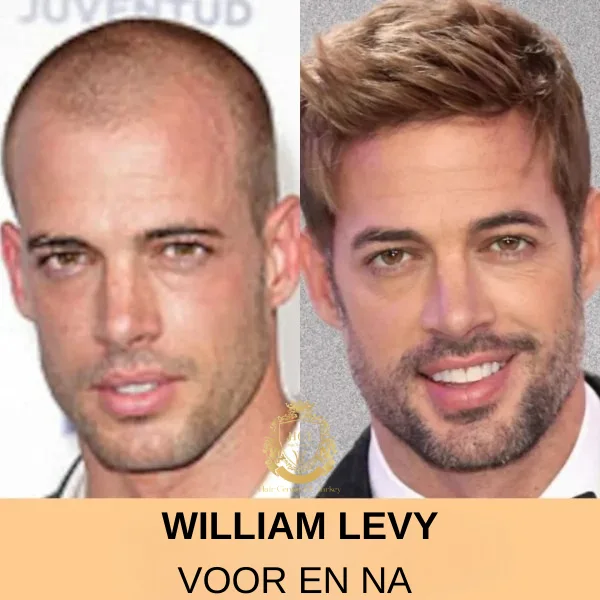 Timbaland Haartransplantatie 78 william-levy-Haartransplantatie