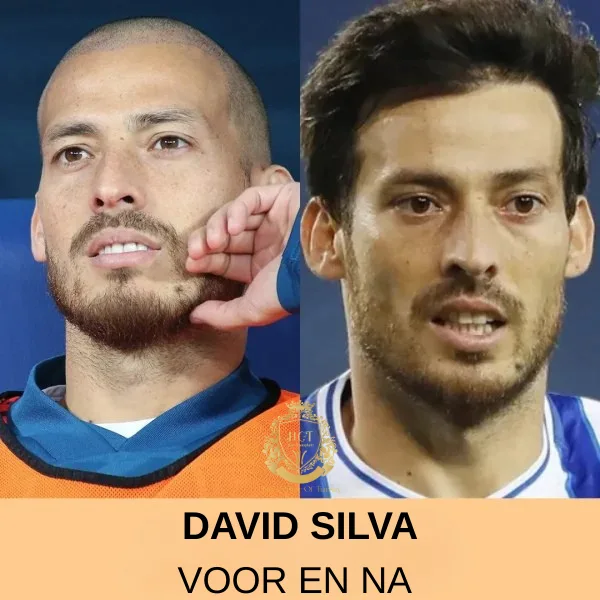 William Levy Haartransplantatie 78 david-silva-Haartransplantatie