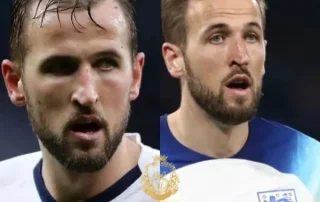 Harry Kane Haartransplantatie 10 Harry Kane Haartransplantatie