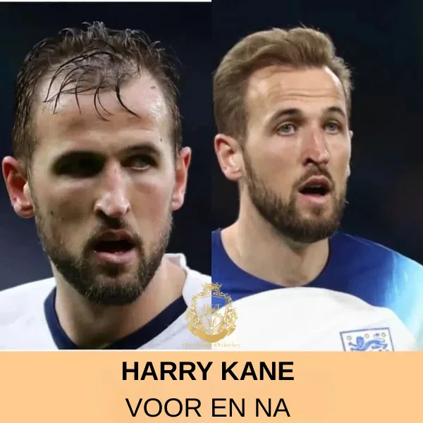 Brett Maverick Haartransplantatie 78 Harry Kane Haartransplantatie