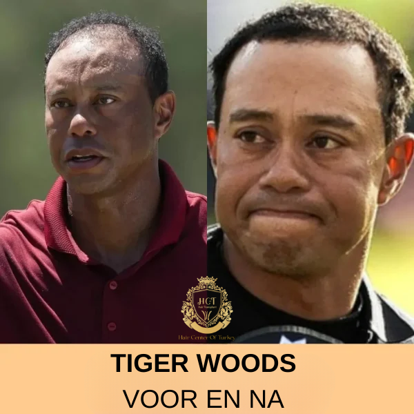 Jimmy Kimmel Haartransplantatie 78 Haartransplantatie Tiger Woods