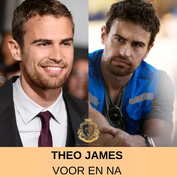 Tiger Woods Haartransplantatie 78 Theo James Haartransplantatie