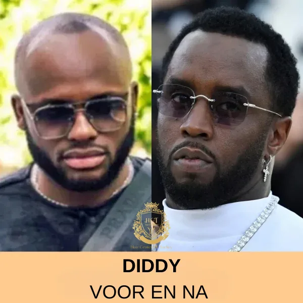 Theo James Haartransplantatie 78 Diddy Haartransplantatie