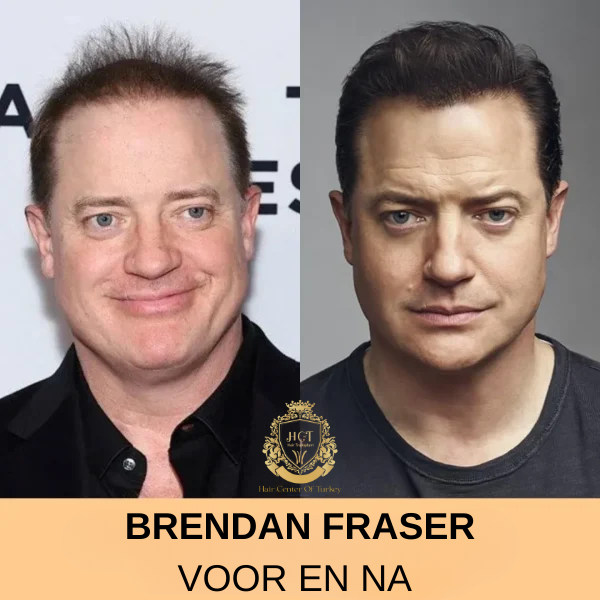 Brendan Fraser Haartransplantatie Brendan Fraser Haartransplantatie