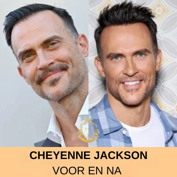 Jon Hamm Haartransplantatie 79 Cheyenne Jackson Haartransplantatie