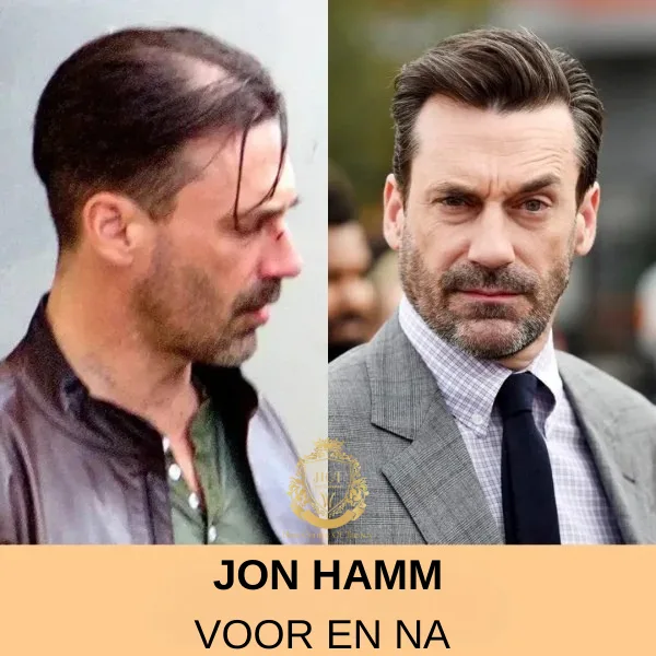 Jon Hamm Haartransplantatie Jon Hamm Haartransplantatie