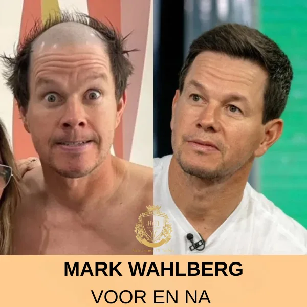 Mark Wahlberg Haartransplantatie Mark Wahlberg Haartransplantatie