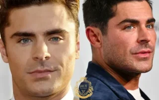 Zac Efron Haartransplantatie 9 Zac Efron Haartransplantatie-foto
