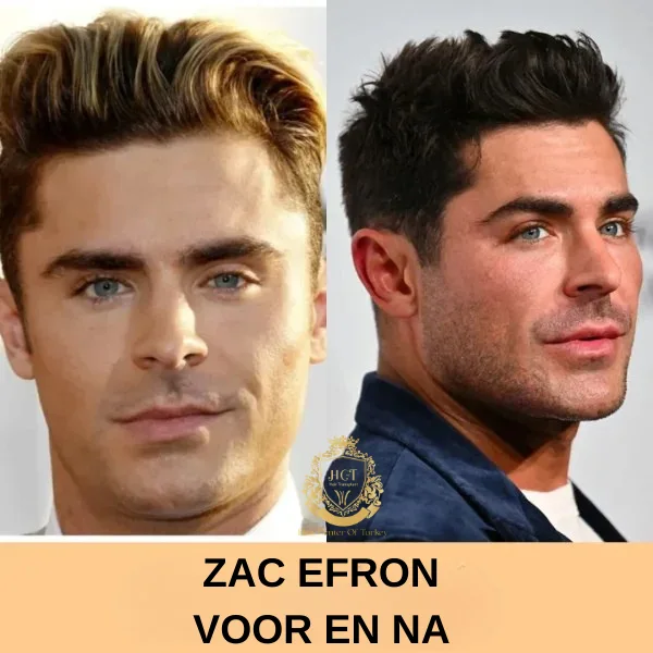 Harry Kane Haartransplantatie 78 Zac Efron Haartransplantatie-foto