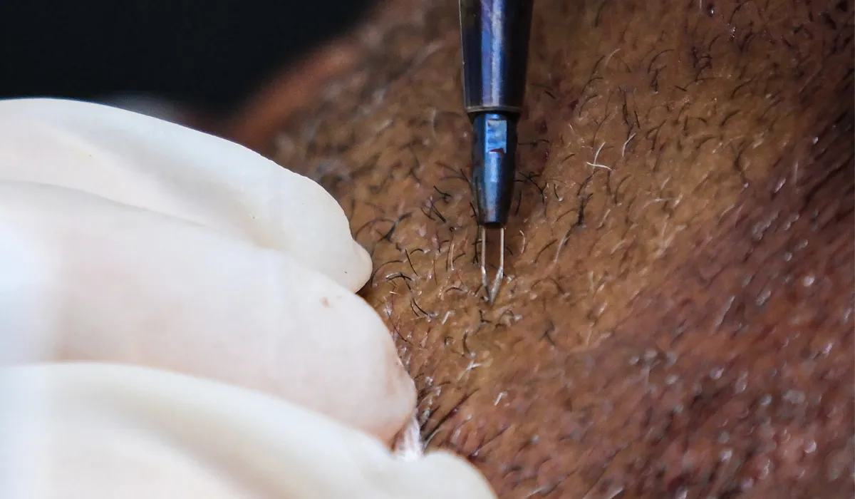 Zac Efron Haartransplantatie-5 Zac Efron Haartransplantatie-5