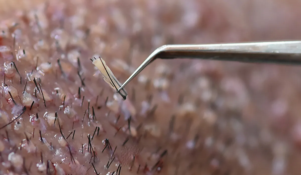 Zac Efron Haartransplantatie-6 Zac Efron Haartransplantatie-6