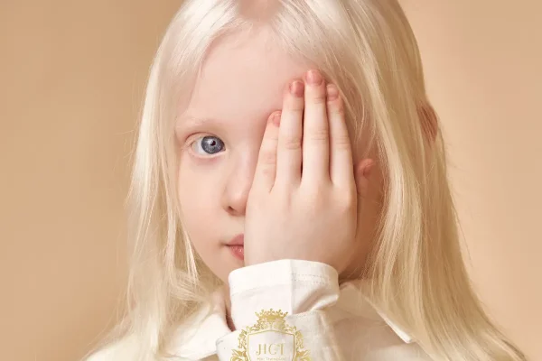 Albinism | What is Albinism | How Does Hair Loss Affect?