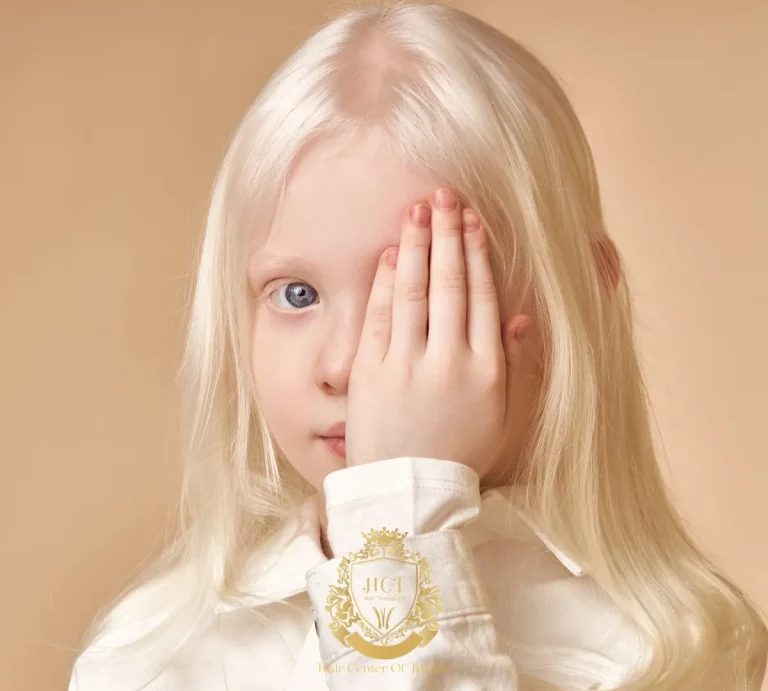 Albinismo | Che cos'è l'albinismo | In che modo influisce sulla perdita dei capelli?