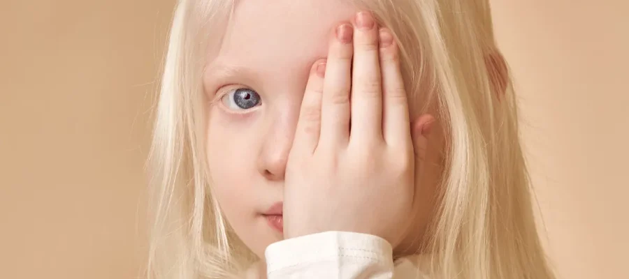 Albinismo - ¿Qué es el albinismo?