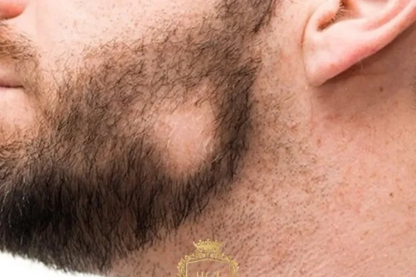 Alopecia Barbae (Beard Alopecia): Causes, Symptoms, Diagnosis & Treatment