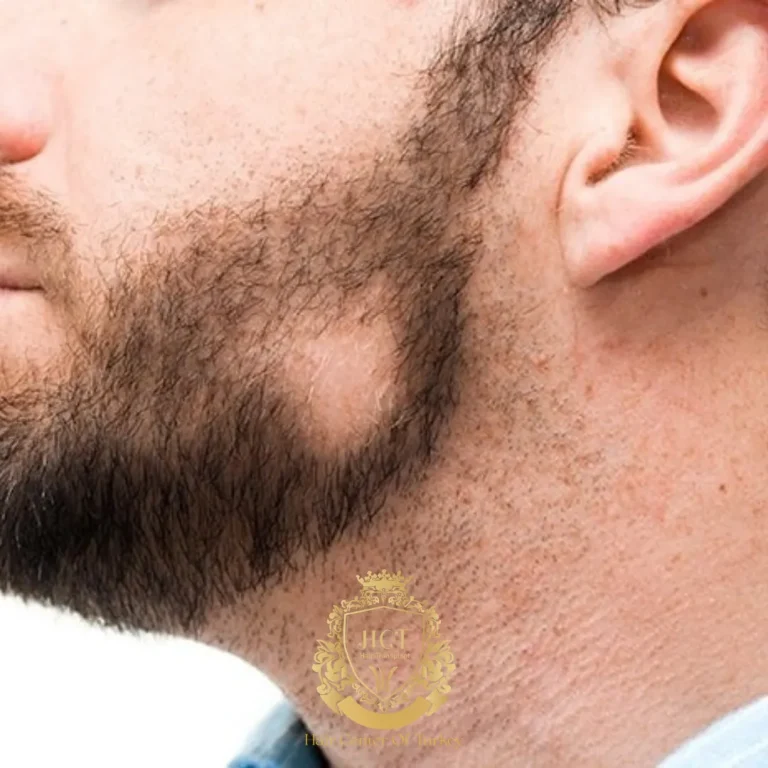 alopecia barbae immagine in primo piano immagini