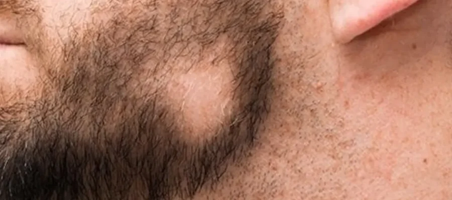 alopecia barbae uitgelichte afbeelding afbeeldingen