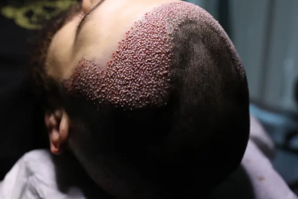 Künstliche Haartransplantation vs. Echthaartransplantation