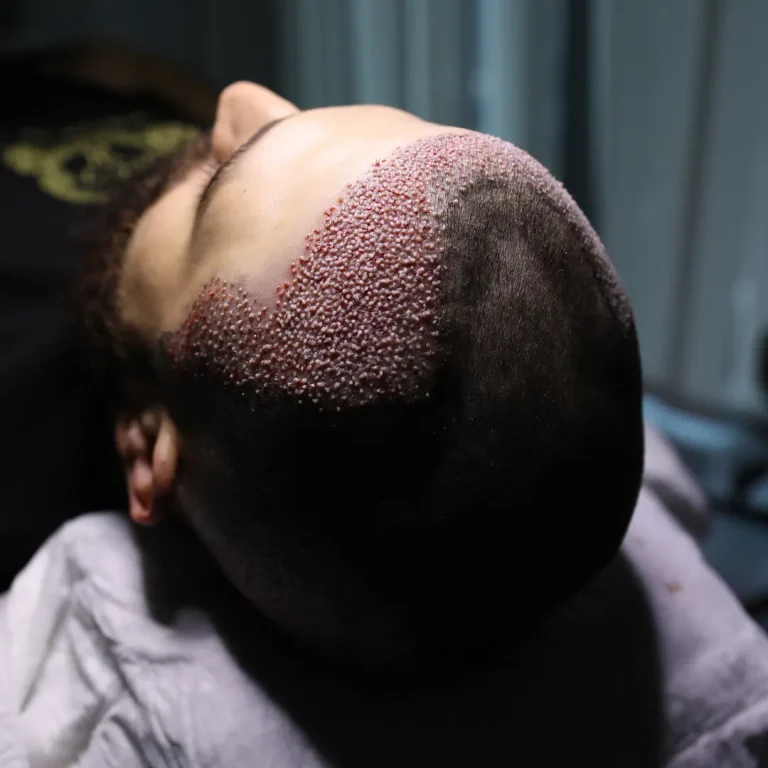 Künstliche Haartransplantation vs. Echthaartransplantation