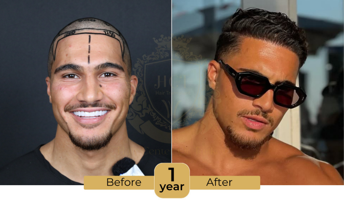 before and after results receding hairline