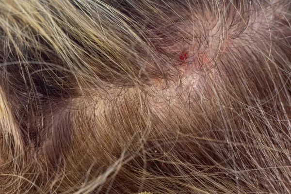 Queimação no couro cabeludo: Causas, sintomas e tratamentos