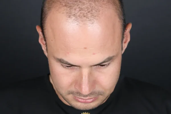 Causes of Baldness in Men and Women