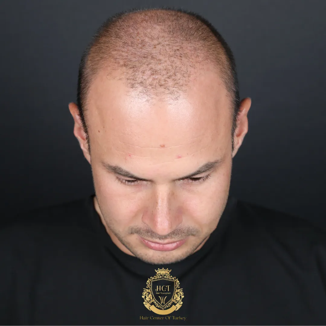 veroorzaakt haaruitval bij vrouwen en mannen