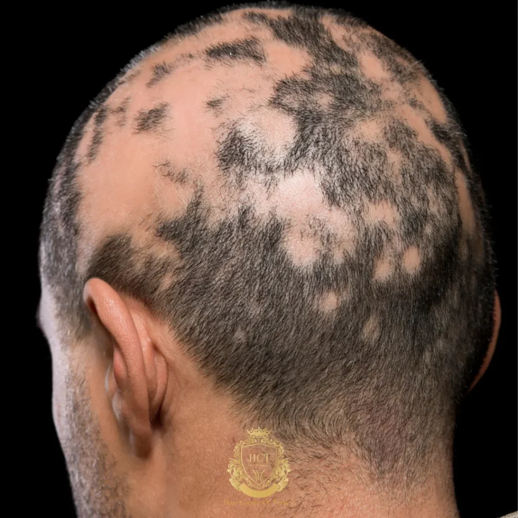 celebrità alopecia fi