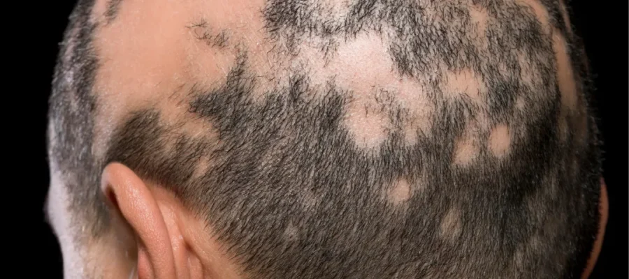 celebrities alopecia