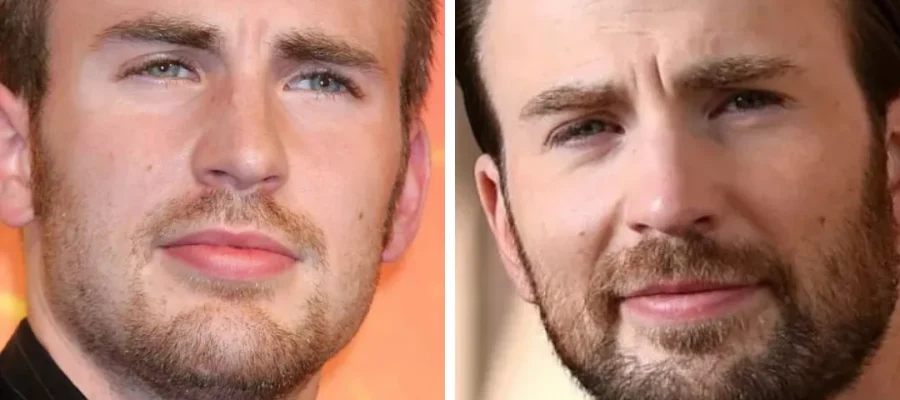 chris evans hair transplant